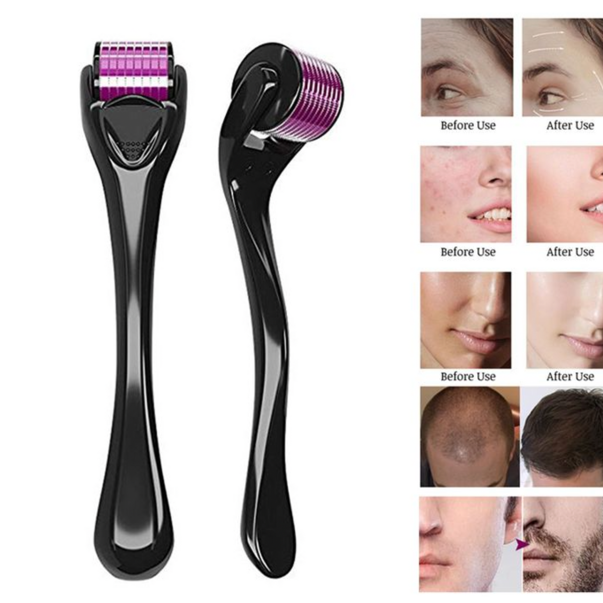 Derma Roller| Micro Needling Treatment