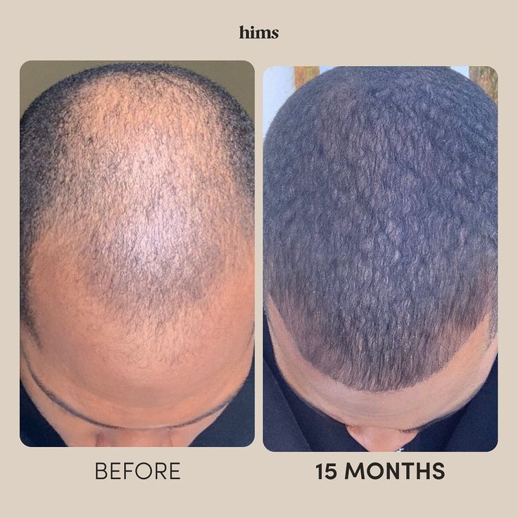 Minoxidil Hair growth Solution