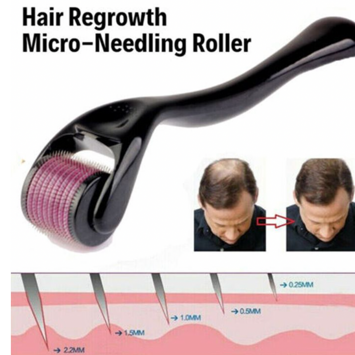 Derma Roller| Micro Needling Treatment