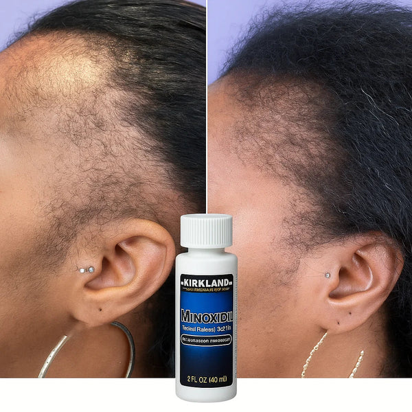 Minoxidil Hair growth Solution
